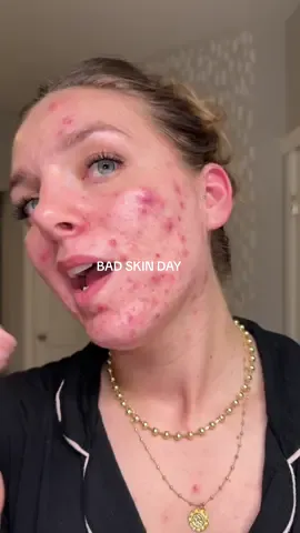 This is for anyone struggling with their skin today 🫶🏼  You are seen You are loved You are validated Keep fighting the good fight Acne SUCKS but it isnt forever We are in this together 💘 #cysticacne #acne #acneskin #acnepositivity #acneproneskin #acnefighter #MentalHealth #acnejourney 