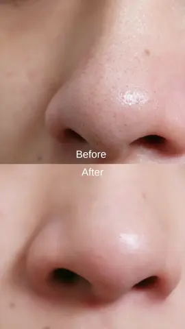hilang terus after guna g2g blueberry facial wash 🙂‍↔️  purchase in showcase! 💜  #glad2glow #g2gblueberryfacewash #facewash #skincare #whiteheads #blackheads 