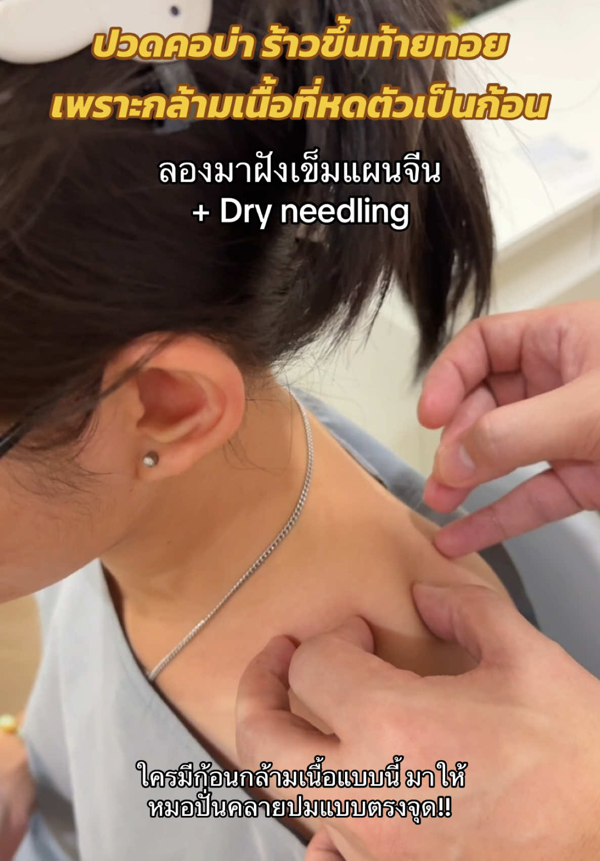ใครที่ปวดคอ บ่า ราวขึ้นท้ายทอย เพราะกล้ามเนื้อที่หดเกร็งเป็นก้อน มาให้คุณหมอปั่นคลายผมแบบตรงจุดกันค่ะ  #dryneedling #ฝังเข็ม #ออฟฟิศซินโดรม #ปวดคอบ่าไหล่ #ปวดหัว #ปวดไมเกรน #ฟาจินคลินิก #แพทย์แผนจีน #ฝังเข็มอ่อนนุช 
