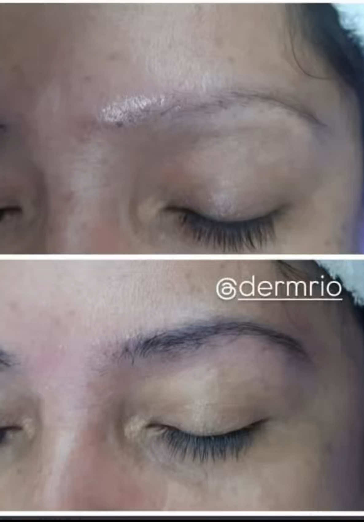 Olha esse resultado com a utilização da Monodose NANOFACTOR TGFB3 #dermrio #estetica #esteticist 