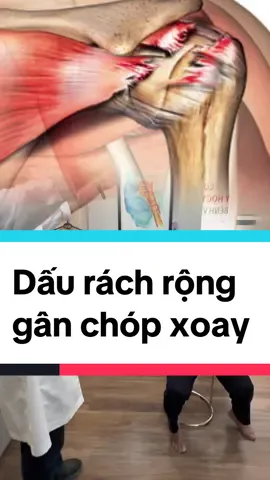 Dấu rách rộng gân chóp xoay - lag sign #rachganchopxoay #daukhopvai #rachgantrengai #benhvienchanthuongchinhhinh #bacsichanthuongchinhhinh #bsnguyenviettan #bscoxuonhkhop #khopvietofficial @BS.CK2. Nguyễn Viết Tân 