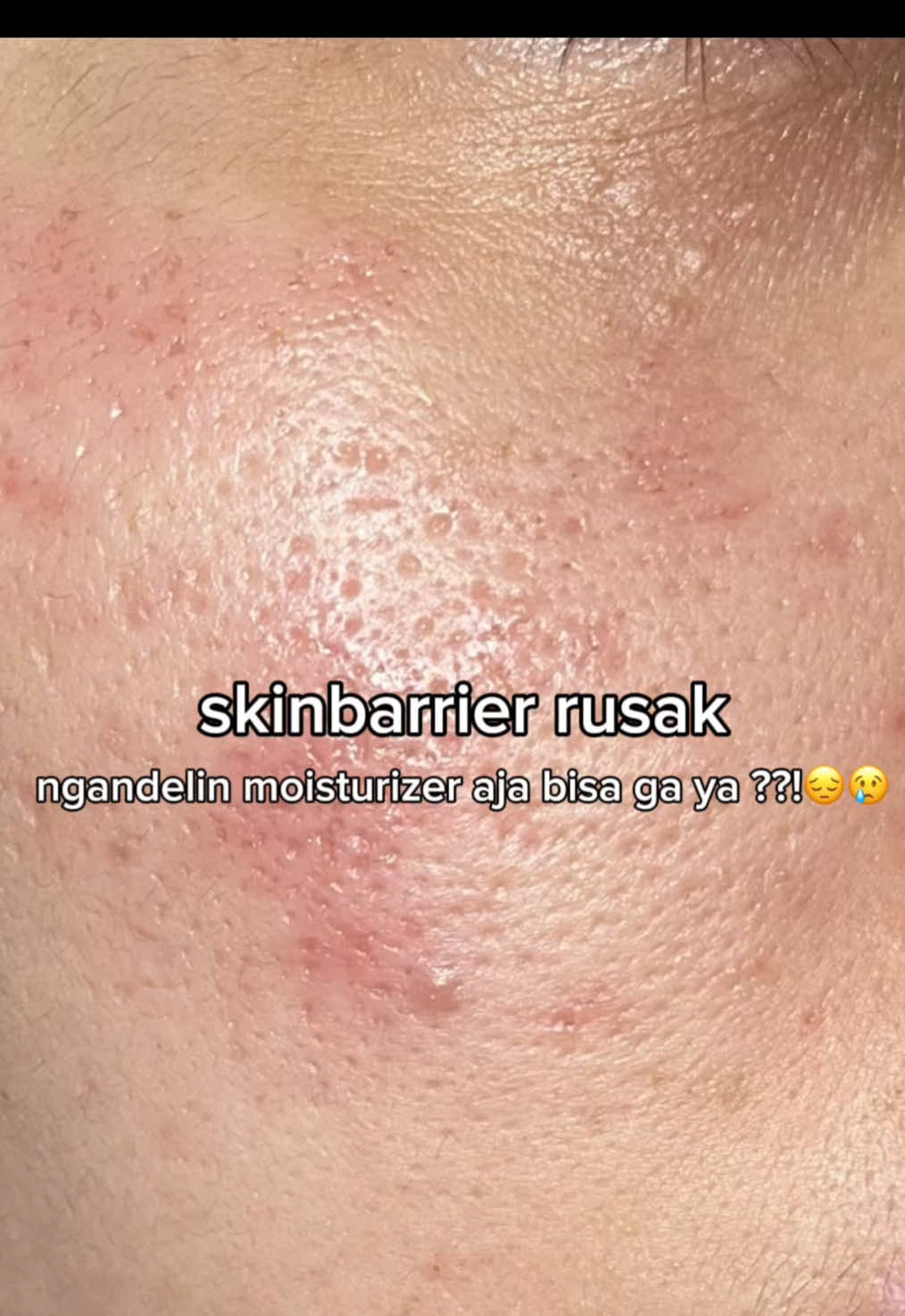 untung ada moisturizernya @Glowsophy kecintaan aku 🫶🏼🥹❤️ #acnemoisturizer #glowsophy #moisturizergel #moisturizer #rekomendasimoisturizer 