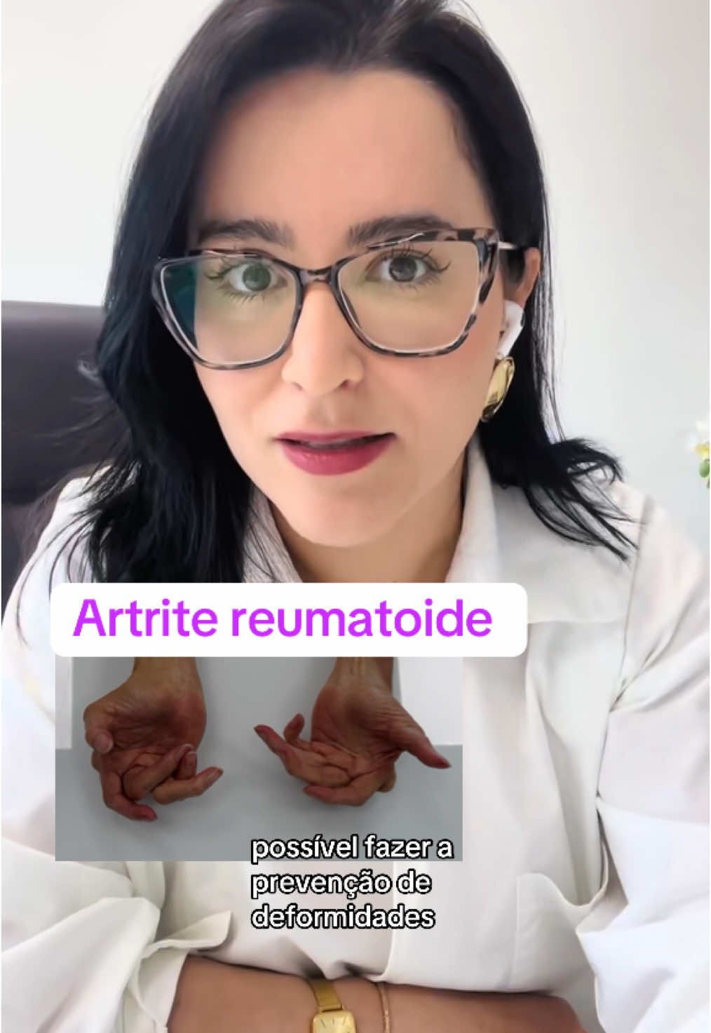 Prevenção de deformidades na artrite reumatoide. #vaiprafy #foryou #fy #fyppp #video #artrite 