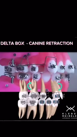 Did you like this video? Follow, like, comment, and share! #orthodontics #klebermeireles #klebermeirelesortho #orthodontistsoftiktok #ortodontia #ortodonzia #orthodontist #orthodontic #klebermeirelesorthodontics 