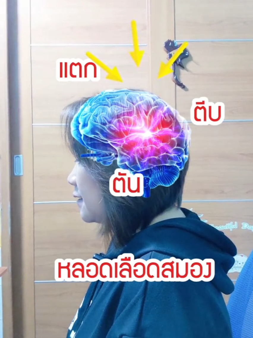 สัญญาณเตือนโรคหลอดเลือดสมองแตก ตีบ ตัน#โรคหลอดเลือดสมอง #หลอดเลือดตีบในสมอง #เส้นเลือดในสมองตีบ #stroke #befast #jaeayhealth 