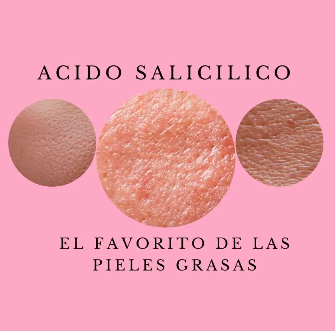 eresbella_oficial El favorito de las pieles grasas 🌸 + El ácido salicílico es un ingrediente muy eficaz en el cuidado de pieles grasas debido a sus propiedades específicas: 1. ✨Exfoliación: El ácido salicílico es un beta hidroxiácido (BHA) que exfolia la piel, eliminando las células muertas y desobstruyendo los poros. Esto es crucial para prevenir la formación de acné y puntos negros.🧖‍♀️ 2. ✨Penetración en el Poros: Su estructura le permite penetrar profundamente en los poros, limpiando el exceso de sebo (aceite), lo cual es beneficioso para las personas con piel grasa.🧖‍♀️🌸 3•✨ Propiedades Antiinflamatorias +: Ayuda a reducir la inflamación y el enrojecimiento, aliviando la irritación asociada con el acné.🥰 4- ✨Acción Antimicrobiana: Tiene propiedades antimicrobianas que ayudan a combatir las bacterias causantes del acné. 5. ✨Reducción del Sebo: Aunque no reduce la producción de sebo, ayuda a controlar el exceso de grasa al limpiar los poros obstruidos. Para obtener los mejores resultados, se recomienda utilizar productos que contengan ácido salicílico como parte de una rutina regular de cuidado de la piel, asegurándose de usar un humectante y protección solar, ya que la exfoliación puede aumentar la