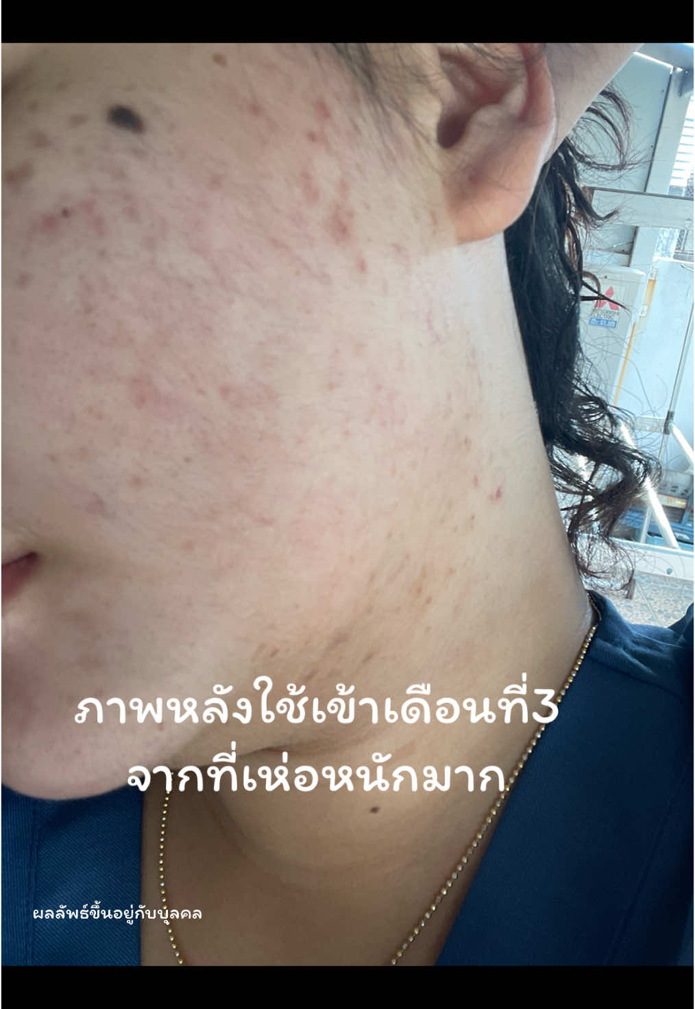 สิวเห่อแพ้ง่าย#เซรั่มรักษาสิว #เซรั่มซ้อกัส #ซ้อกัส #ครีมแก้สิว #สิวเห่อ #สิวแพ้สาร #สิวแพ้แมส #สิวแพ้เหงื่อ #หน้าติดสาร #หน้าติดสารปรอท #หน้าติดสารเสตียรอยด์ 