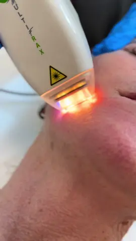 il nuovo Multifrax, un piccolo dispositivo considerato «non convenzionale», perché sfrutta una doppia sorgente luminosa che non risulta invasiva. Si tratta di un unico sistema di ringiovanimento che emette due laser non ablativi a differenti lunghezza, che agiscono in contemporanea. A livello cutaneo, l'energia prodotta dai raggi laser stimola i fibroblasti a generare nuovo collagene ed elastina. In questo modo i tessuti si rimodellano e la pelle risulta più levigata e ringiovanita. Il nuovo strumento fa ottenere un incarnato più luminoso, visibilmente più liscio e compatto, con risultati che risultano sempre più evidenti nel corso del tempo. Risulta efficace sulle rughe, sulle macchie cutanee, sulle cicatrici da acne , sulla mancanza di tono cutaneo e sui danni causati dal foto- invecchiamento.  #lasernonablativo #resurfacing #rughe #macchie #fotoaging #fotoringiovanimento 