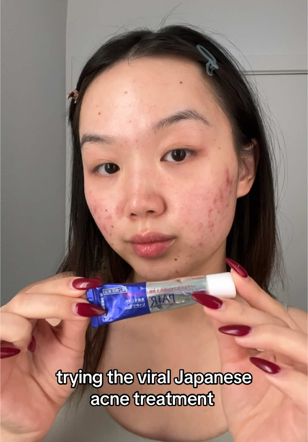 I’ve gotten so many people telling me to try this Pair cream so follow along to see the results 🤭💪 #acne #hormonalacne #acnetreatment #viral #skincare #skincaretips #clearskin #SkinCare101 