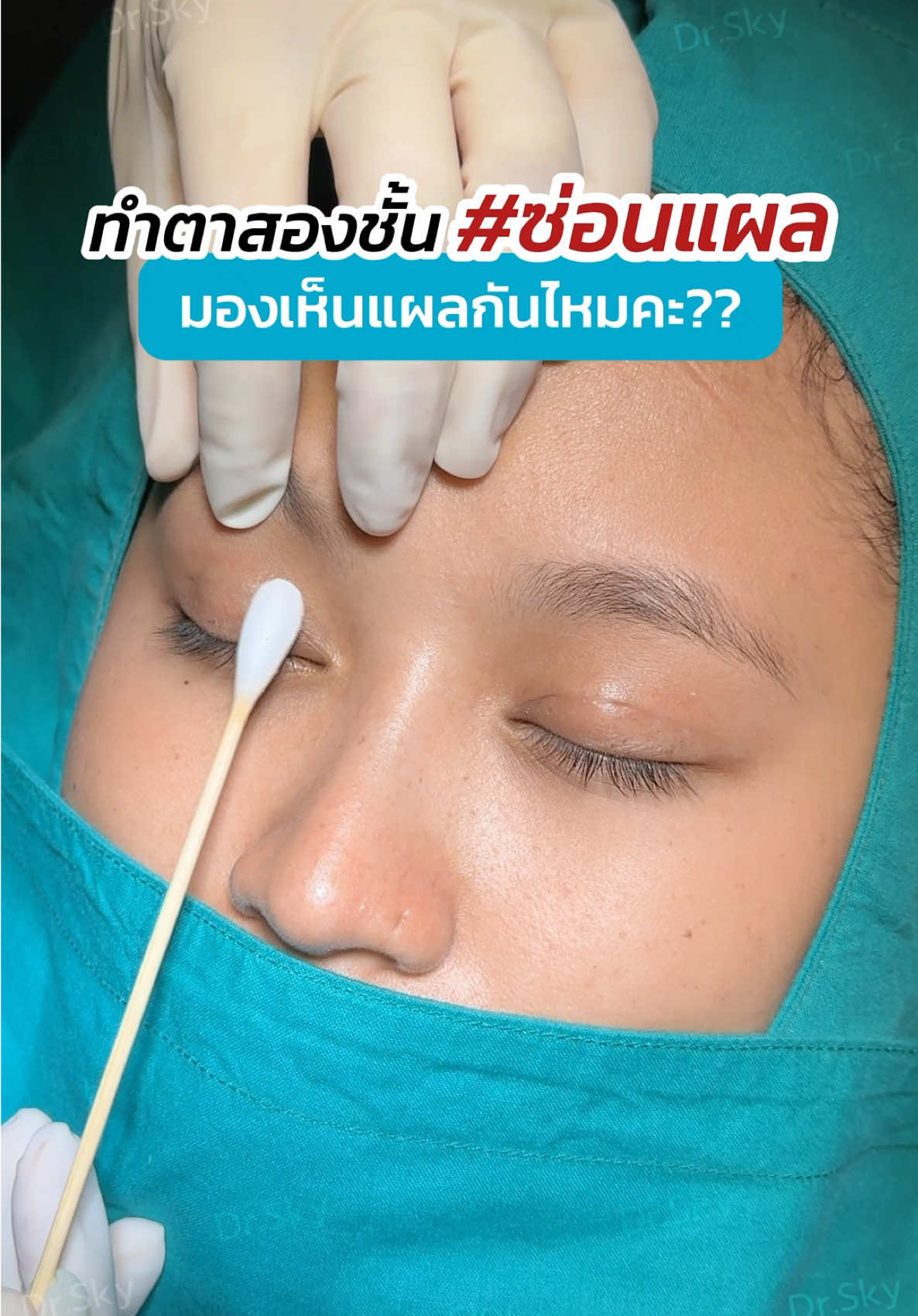 ทำตาสองชั้น ซ่อนแผล 😲 มองเห็นแผลกันไหมคะ ⁉️ #sweeteyes #หมอสกาย #หมอตา #skyclinic #ทำตาที่ไหนดี #จักษุแพทย์ #รีวิวตาสองชั้น #ชั้นตาไม่เท่ากัน #หนังตาตก #สกายคลินิก #ศัลยกรรมตา 