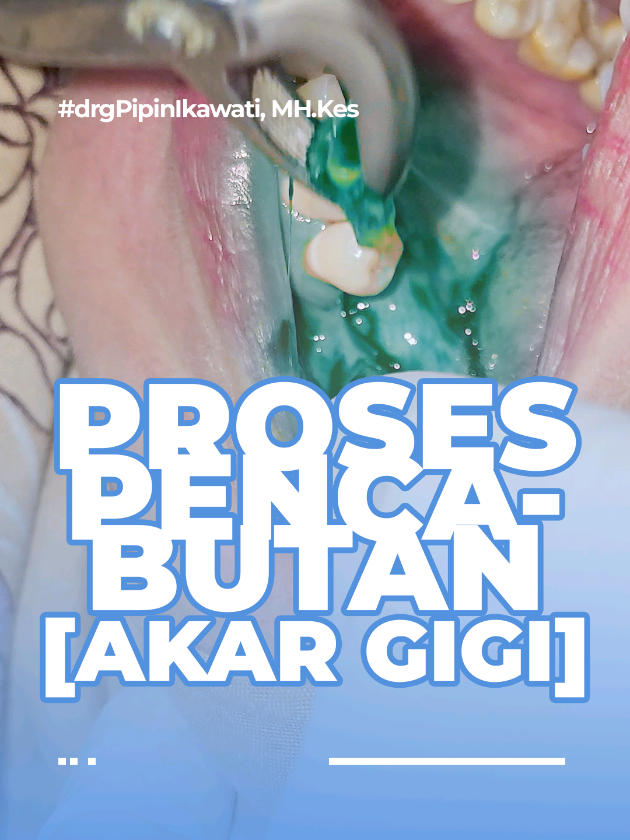 Proses pencabutan sisa akar gigi. #teethcleaning #dentalhygienist #dentist #doktergigi #teeth 