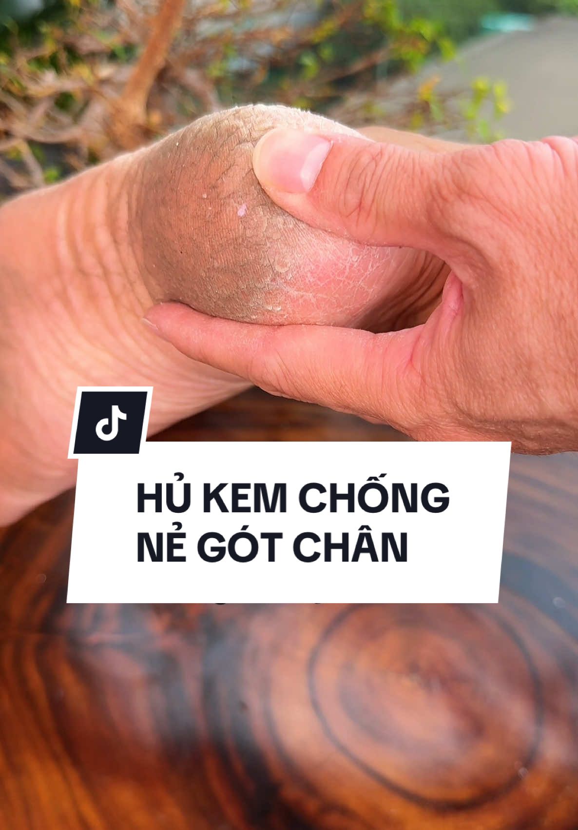 Kem chống nứt nẻ gót chân hiệu quả #kemchongnegotchan #kemchongnutne #kemduonggotchan #dcgr #khatienich 