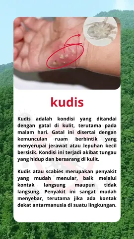 #kudis #korengan #obatgatal #penyakitkulit #sabuncabiyes #kurap #gatal #panu