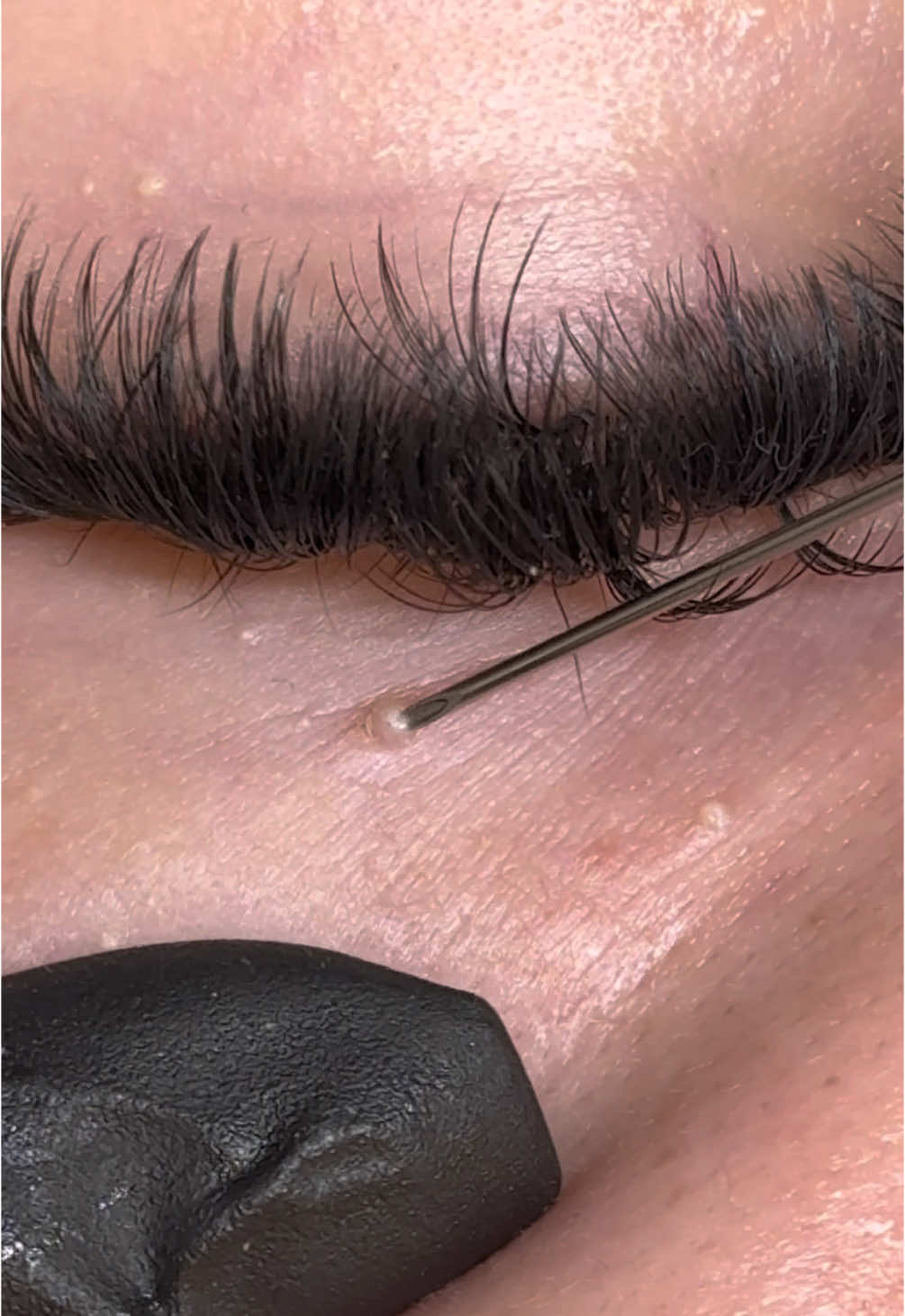 Satisfying Milia removal! #extraction #extractions #blackhead #blackheadsremoval #milia 