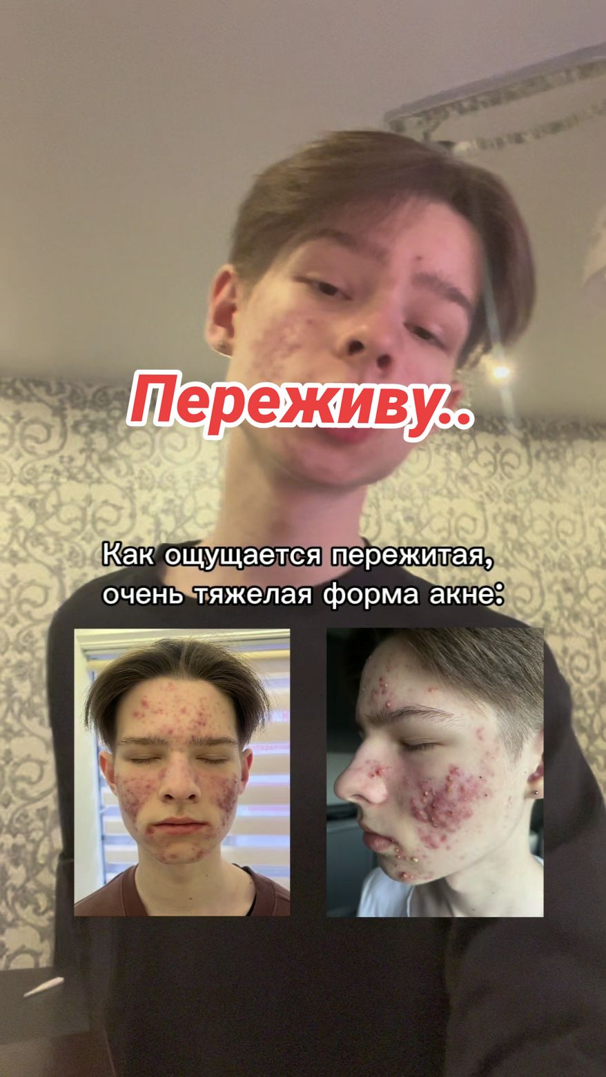 В тг результаты лечения 💆🏻‍♀️ #акне #уходзакожей #проблемнаякожа 