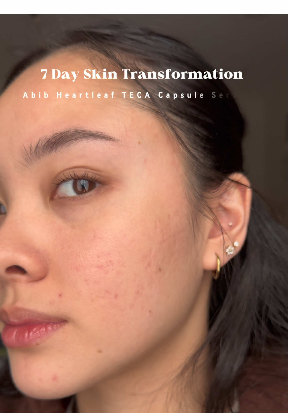 Stay until the end of the video for results! 7 Day Skin Transformation for acne prone? Trying out the Abib heartleaf TECA Capsule Serum. Abib products are available on Amazon!! #abib #TecaSerum #7DaysChallenge #acnejourney #abibcapsuleserum #acneserum #noncomedogenic #acneproneskin #acnescar #redness #blemish #pimple #heartleaf #acnetreatment #essence #ampoule #kbeauty #koreanskincare #fyp @Abib Cosmetics 