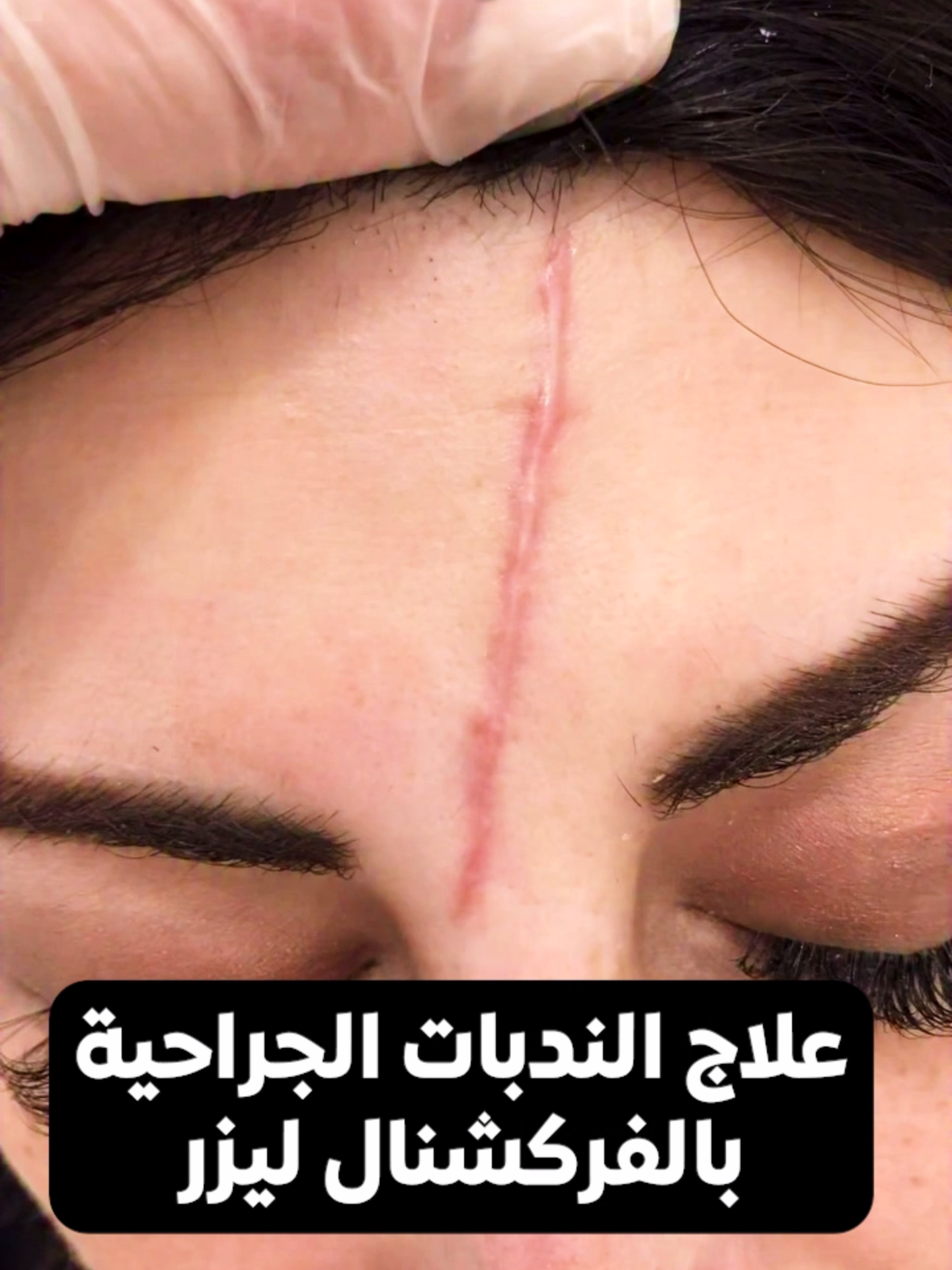 الفراكشنال ليزر 🤔🤔 هو الحل الأمثل للتخلص من الندبات و حب الشباب والزوائد الجلدية في أسرع وقت 👈برنامج مخصص لنضارة طبيعية بتغير طبقات الجلد المرهقة 👈 فى جلسات معدودة تقدر تخفى الاثار القديمة و الزوائد الجلدية احجز موعدك الآن 😍#ليزر_ازالة_الشعر#علاجات_طبيعيه#طبيب