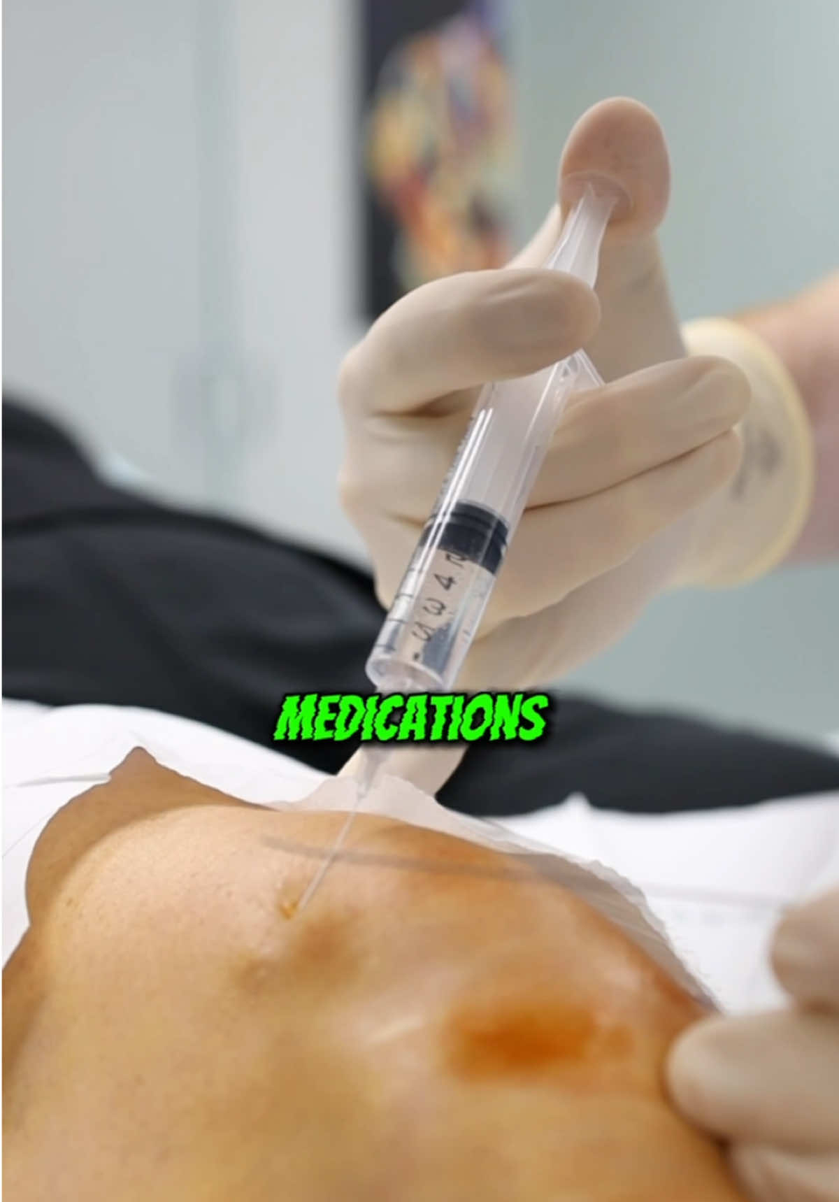 Is there a way to avoid knee surgery?  Did you know you can avoid knee surgery in many cases? Treatments like nerve blocks, gels, steroid injections, and other procedures can help relieve pain and restore movement. Surgery isn’t always the answer—explore your options! #kneesurgeryrecovery #painmanagement 