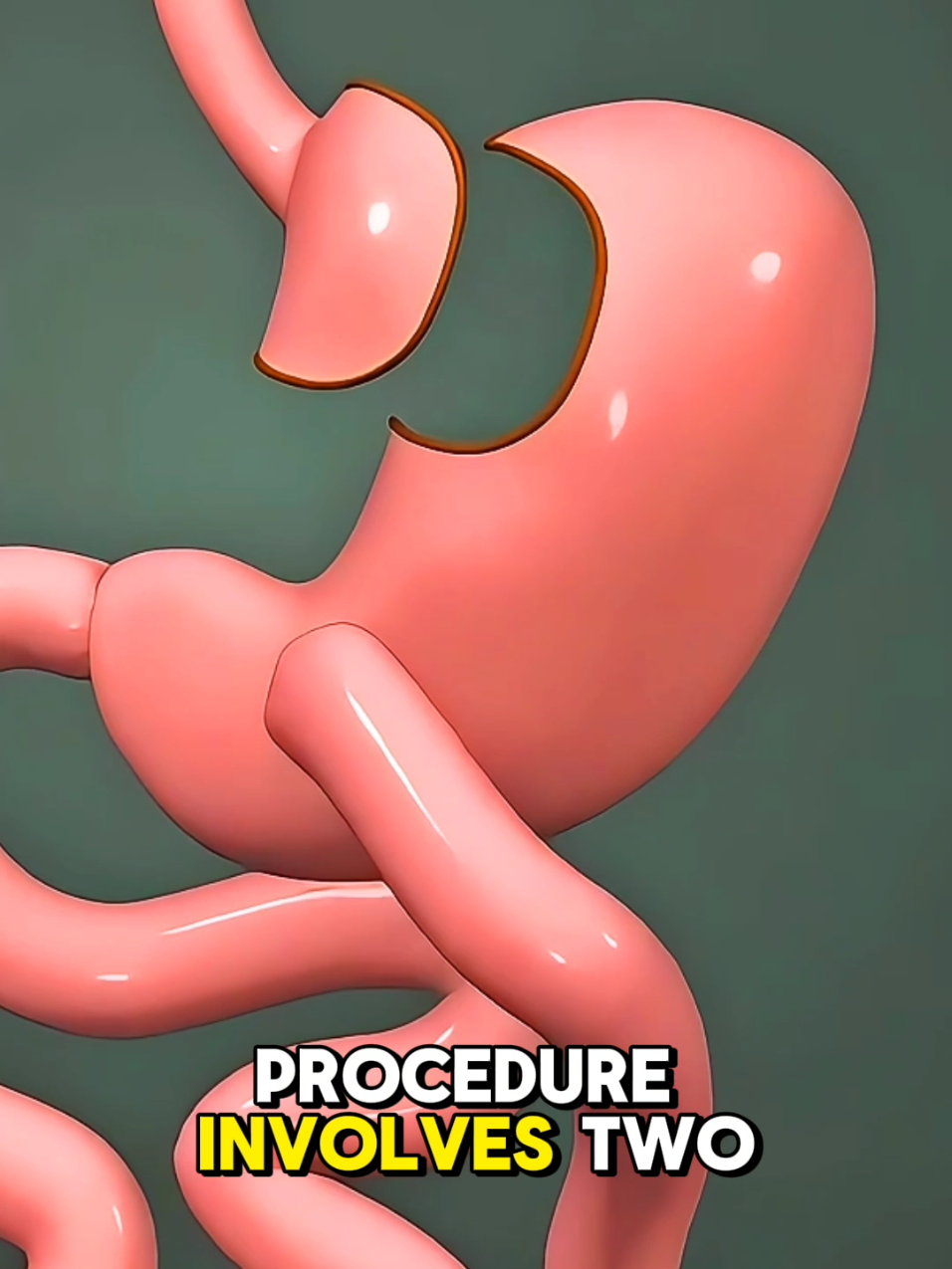 Gastric Bypass Surgery 3D Animation #gastricbypass #gastricbypasssurgeryjourney #weightlossjouney #weightlossprogress #stomachsurgery #stomachbypass #bariatricsurgery #medical3danimation #3dmedicalanimation 
