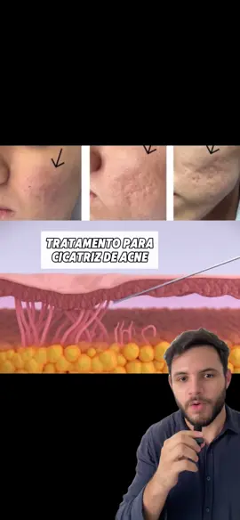 Já ouviu falar em bioestimulador de colágeno? O bioestimulador de colágeno é uma ótima opção para quem quer melhorar a qualidade da pele e amenizar cicatrizes de acne.  #dermatologist #bioestimuladordecolageno #cicatriz #acneskin 