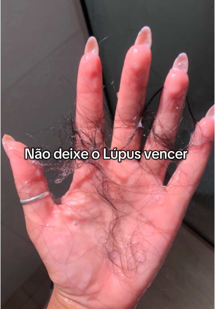 O “Lupús” n vai me vencer… Eu n vou deixar 💪🏽❤️‍🩹     #lupus #autoimmune #lupuswarrior #lupuswarrior🦋💜 #autoimmunedisease #doenca #autoimmunewarrior 
