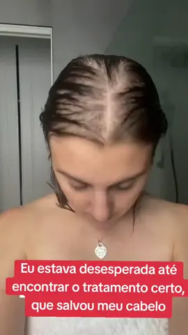 Reduziu a queda em até 95% Acelerou  7x o crescimento, Combateu alopécia. Fiz o tratamento certinho, e hoje estou muito satisfeita, o meu cabelo tá lindo, cheio e sem cair. #fouryou #quedadecabelo #videoviral #alopecia #fyp 