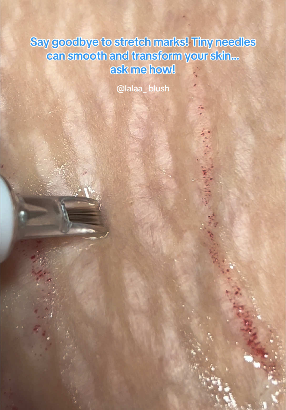 Goodbye Stretch Marks! #inklessstretchmarkremoval #stretchmarkremoval #medicaltattootraining #austin #texas #elpaso #skincamouflagetraining #medicaltattooartist #dallas #houston #losangeles #inklessstretchmarksremovaltraining #scarcamouflage #sanantonio #newcareer #2025 #stretchmarks #stretchmarkremoval #scars #fyp 