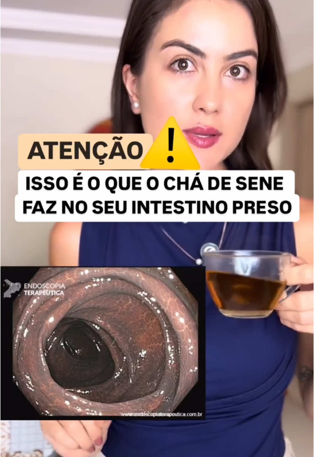 Isso é o que o chá de sene pode causar no seu intestino preso 😱💩 Já pensou nisso? Ele força um movimento que o seu intestino não está conseguindo fazer naturalmente, e isso aumenta a inflamação. São as inflamações que fazem o intestino prender, porque você tomar um chá que aumenta a inflamação? Você precisa desinflamar! E não há outra forma de fazer isso, se não no evento O FIM DO INTESTINO PRESO, um evento online com três aulas gratuitas com os primeiros passos da desinflamação bionatural. ✅ Quer participar? Clique no link aqui do perfil e inscreva-se para O FIM DO INTESTINO PRESO #laxante #laxantenatural #intestino #intestinopreso