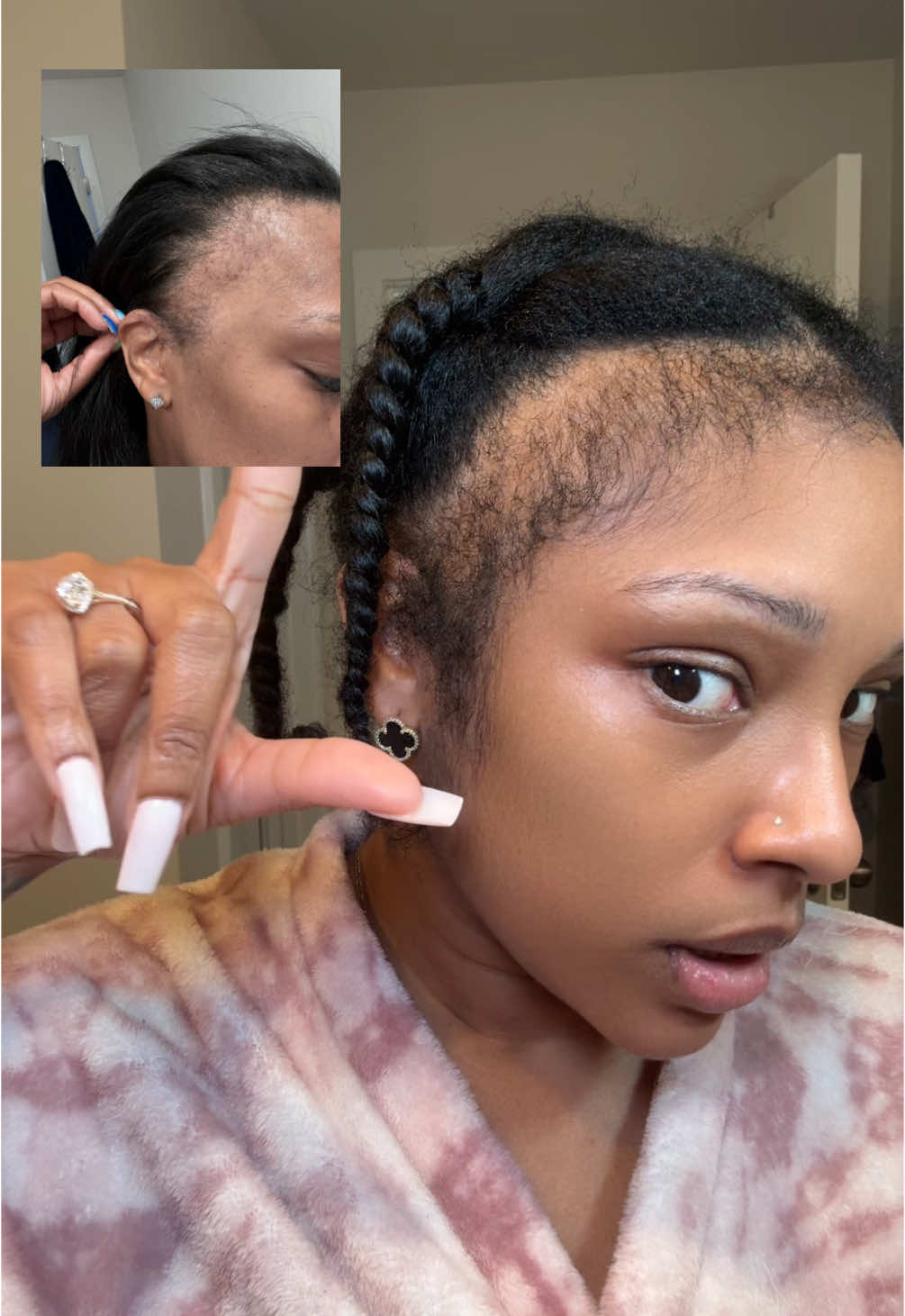 This might be the LAST UPDATE before TikTok is Banned 😭 5.5 months we been on this ride together! I hope to see yall on the other side again soon 😭💕 #minoxidil #minoxidilresult #tiktokban #tiktokban #fyppppppppppppppppppppppp #recedinghairline 