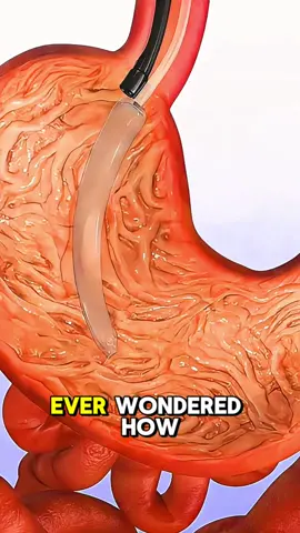 Bariatic Balloon Procedure Medical Animation 3D #gastricsurgery #bariaticsurgery #bariaticsurgery #gastricsleevesurgery #gastricsleevejourney #weightlosssurgery #medicalanimation 