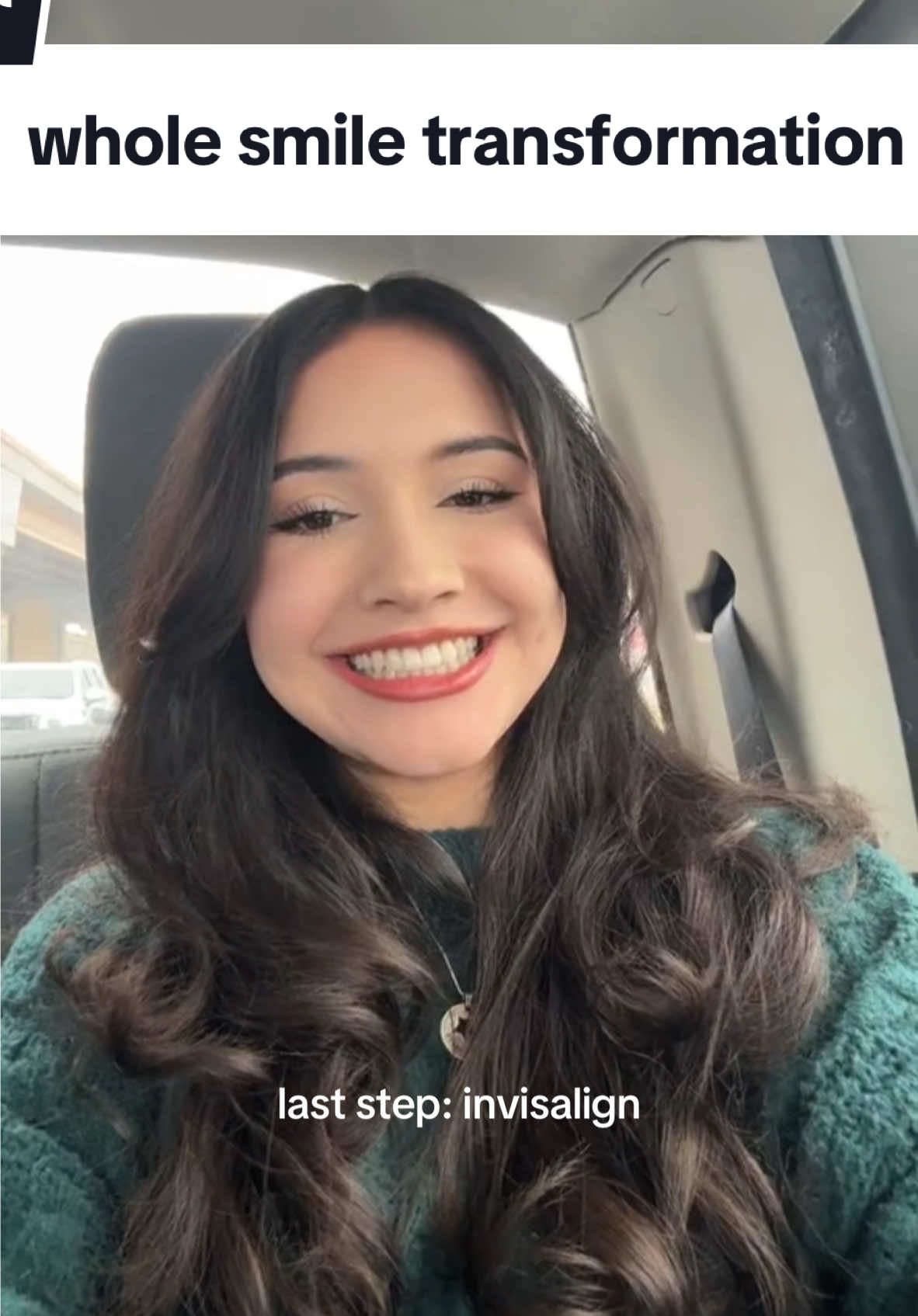 ty tiktok for helping me document. this journey healed me but so did all of you❤️‍🩹   #braces #bracesoff #bracesjourney #GlowUp #beforeandafter #teeth #toothless #impactedcanine #missingteeth #dentalimplants #fyp #savetiktok #tiktokban 