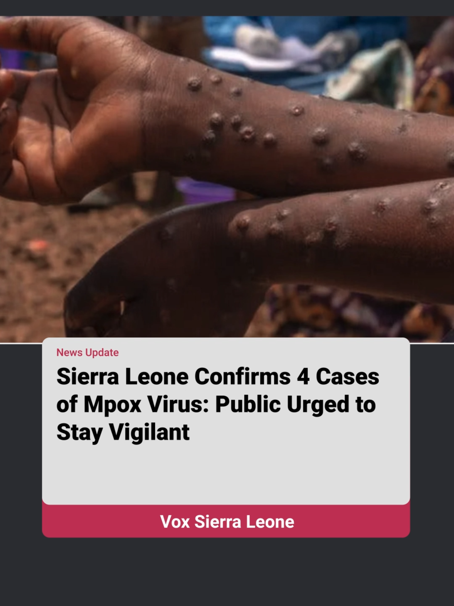 The Government of Sierra Leone has confirmed four Mpox cases in Western Urban and Rural areas, with one female and three male patients. Citizens are urged to practice good hygiene, report suspected cases via the 117 hotline, and cooperate to contain the outbreak. No recoveries or deaths have been reported so far. #MpoxOutbreak #SierraLeone #PublicHealth #StaySafe #HealthUpdate #BreakingNews #CommunityAlert #sierraleonetiktok🇸🇱🇸🇱🇸🇱