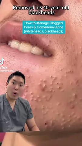 #duet and #stitch @Jasmine very satisfying!🙌 I wanted to add prevention strategies as well 💪 hope this helps 🤙#cloggedpores #cloggedporesroutine #retinoid #adapalene #drsugaiskincare #acne #blackheadextraction #porestripremoval #porestrip 