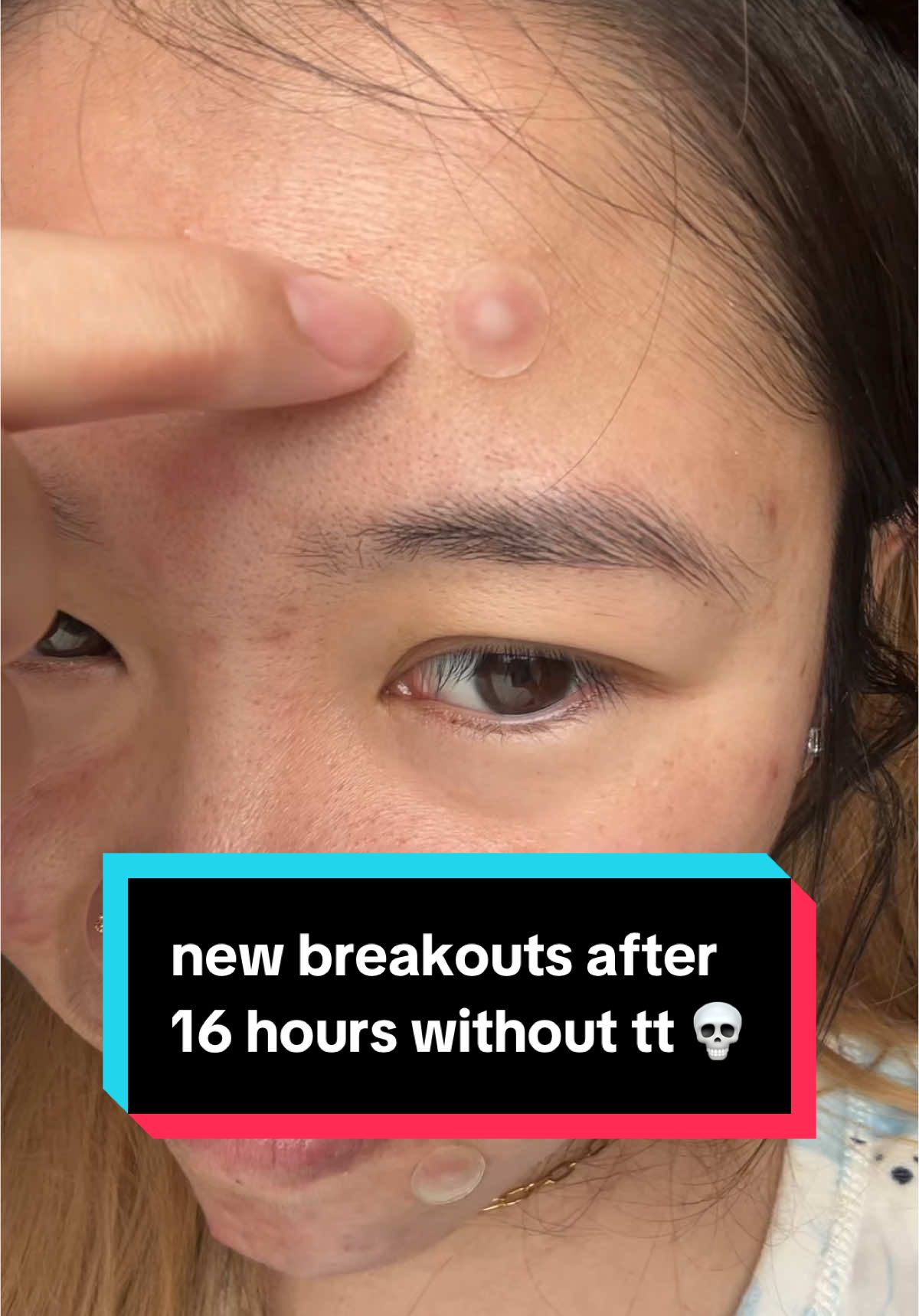 i was so bored last night without tt 🥲 #weareback #pimplepatch #acne #skincare #pimplepatchpeel 