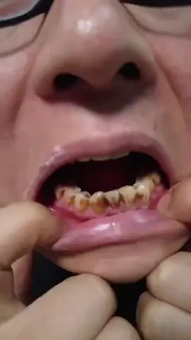 karang gigi langsung rontok hanya pakai pasta gigi ini #sip4 #pastagigi #pemutihgigi #karanggigi #rontokinkaranggigi #gigikuning 