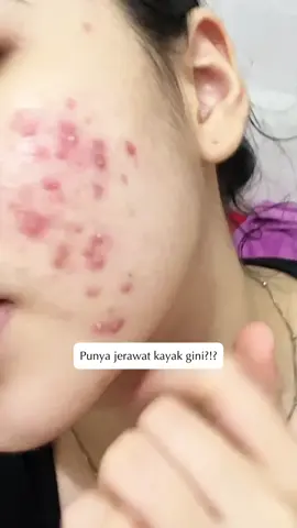 Nasib punya kulit jerawatan terus, kapan ya bisa mulus 🥹 #skincare #viral #fyp #facemask #skincarehacks #skincaretips #glowing #glassskin #jerawat #acnefighter 