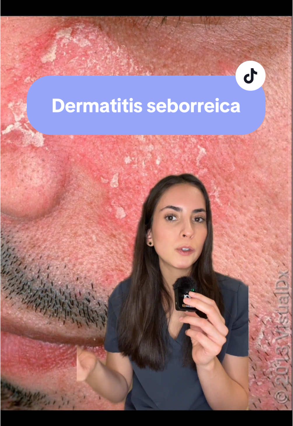 No es resequedad, es dermatitis seborreica. Si presentas eritema (rojito) con escama amarillenta oleosa.. ponerte cremas pesadas no te ayuda. Te dejo unos tips para combatirla #derma #dermatitis #dermatitisseborreica #skincare #skincaretips #skincareroutine #caspa 