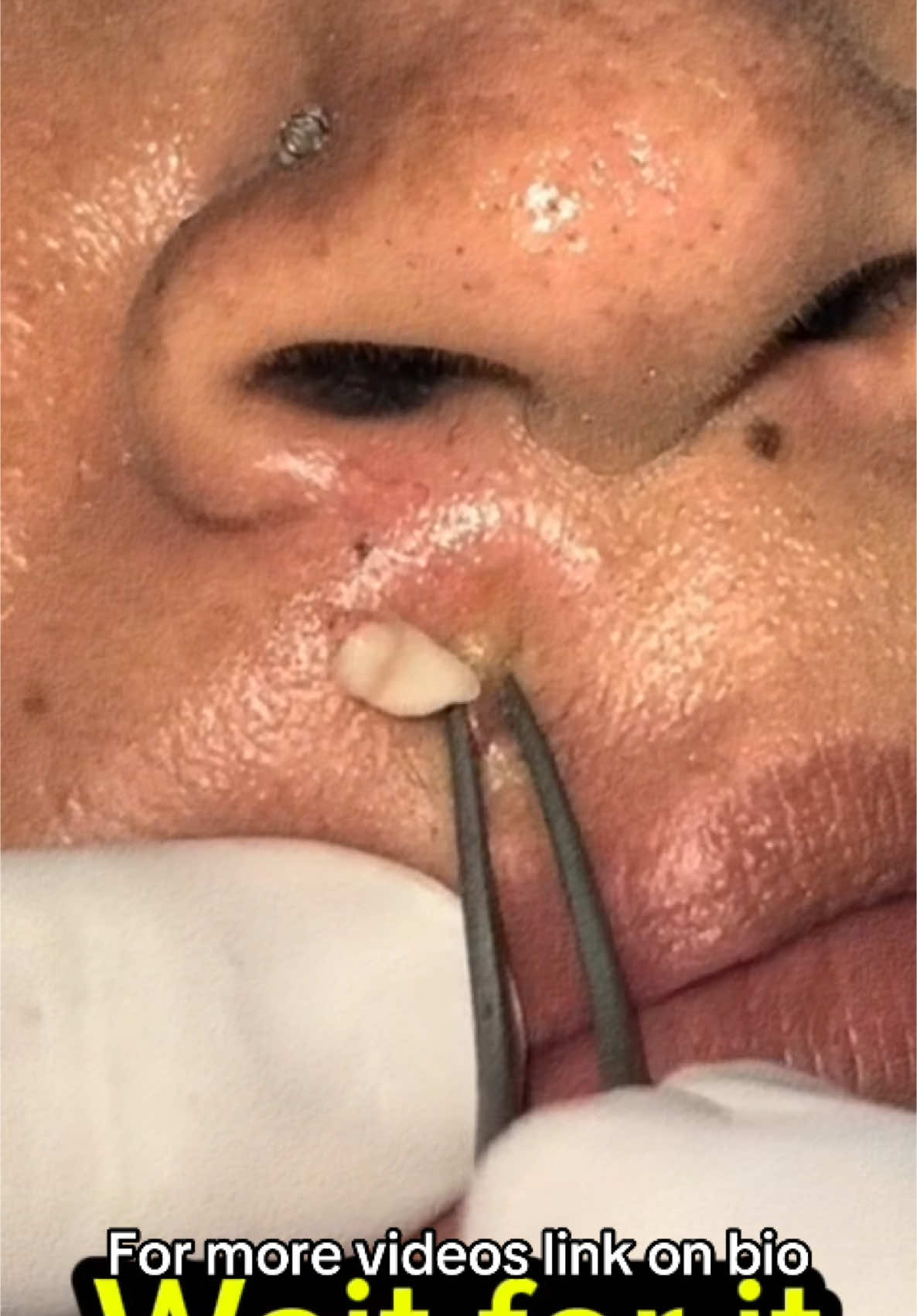 Oddly satisfying popping videos #pimple #pimplepop #pimplepopper #pimplepatch #blackhead #blackheads #blackheadsremoval