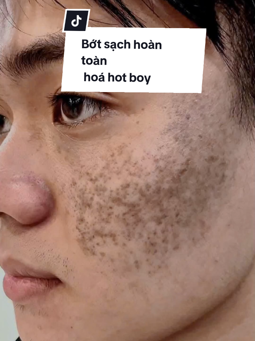Mỉm cười lạc quan điều trị bớt bạn sẽ có được ngoại hình như ý muốn