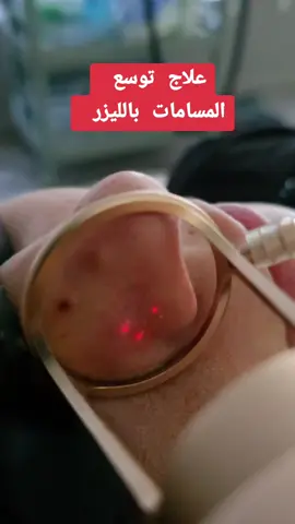 علاج توسع المسامات بالليزر  عيادة الدكتورة تعابني آسيا لطب التجميل والليزر عين بيضاء ام بواقي 0664207194 #خنشلة_باتنة_ام_البواقي_سطيف_شاوية #الشعب_الصيني_ماله_حل😂😂 #syabeautyclinic #فراكشنال #توسع_المسامات #مسامات_واسعة #مسام #laserco2fractionné#pores #طبيبة @syabeautyclinic 