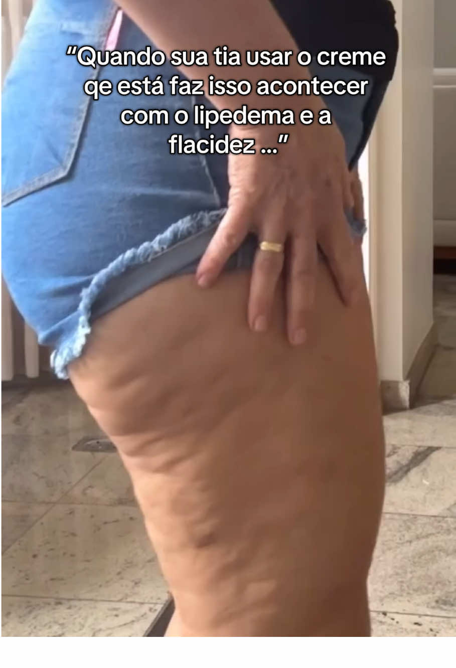 Foi a melhor escolha dela, melhora mais que estamos gostando muitooo 🥹🥹 #lipedema #autoestima #fyb #flacidez #foliculite 