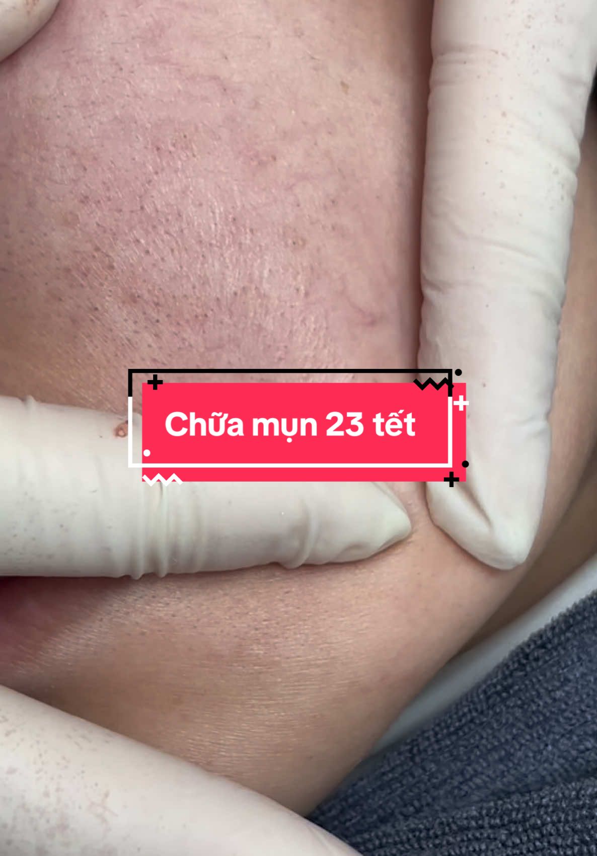 23 tết mới chịu mang mặt mụn đi chữa#dieutrida #xuhuong #dieutridakhoahoc #nanmun #nanmunbangtayuytinhanoi #nanmunbangtayuytinhanoi #nanmunbangtay #mesotherapy #peel #fyp 