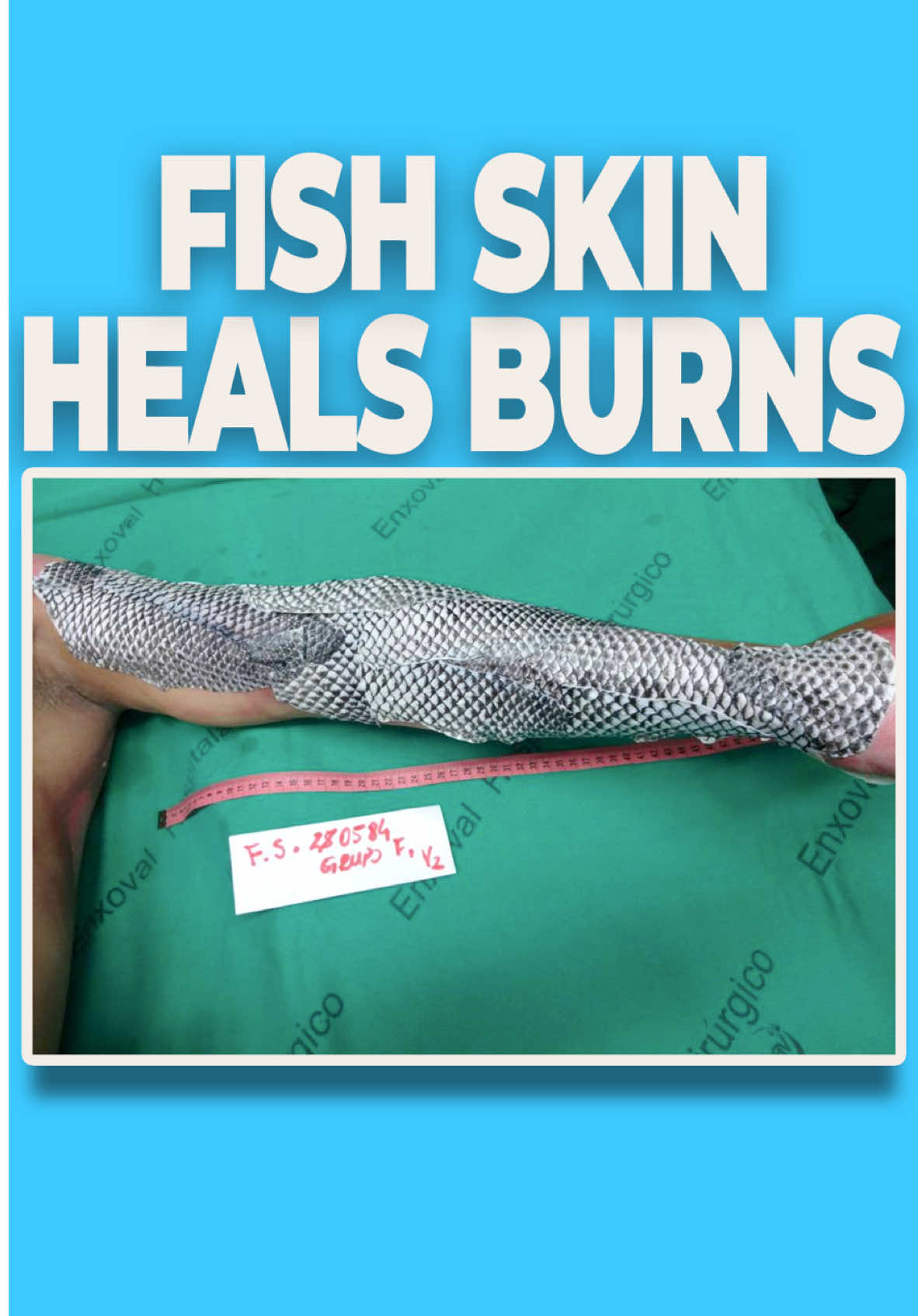 Fish Skin Heals Burns Fish skin, especially Nile Tilapia skin is an effective way to treat burns, but it also reduces pain levels significantly. because its collagen closely matches human skin, it creates a moist healing environment. Credits:  @ VOANews, Statnews, GTworker & PRSJournal / YT #tech #technology #engineering #innovative #fyp 