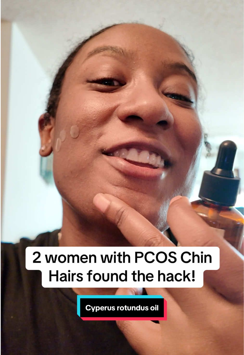 UPDATE: Her chin hairs reducing and she been hardly touching the tweezers now, this Cyperus Rotundus oil is a game changer! This oil is INSANE🔥 #pcos #chinhair #hairychin #hairy #pluckingchinhair  #Hirsutism  #FacialHair #Hormones #Scar #FacialHairRemoval #Tweezers #ScarTreatment #PCOSCysters #PCOSSkincare #PCOSHair #AcneScars #AcneHelp #SkinHacks #cyperusrotundus #cyperus #pcosawareness #pcoslife #TikTokShopYearEndSale #TikTokShopLastChance #tiktokmademebuyit #whattiktokmademebuy #treasurefinds #tiktokshopcreatorpicks #shoplunarnewyear #tiktokshopnewyearnewaura #ttsdelight #ttslevelup 