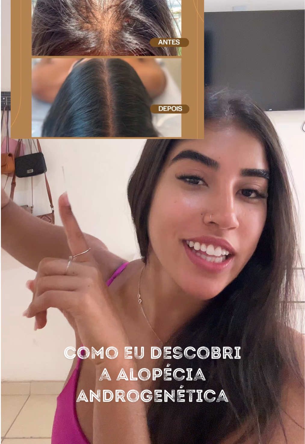 qualquer queda intensa, procurem saber o motivo!! #fyp #vaiprafy #alopecia #alopeciaandrogenetica #calvicefeminina 