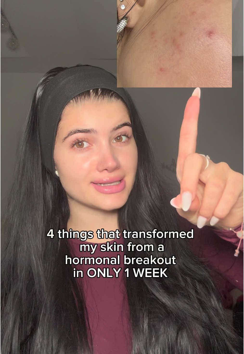 4 things that helped me to get rid of a hormonal breakout in 1 WEEK ONLY 🤭✨🫧 #GlowUp #glowuptips #acnetreatment #acne #fyp #skintok #skincaretips #healthyskin #clearskin 
