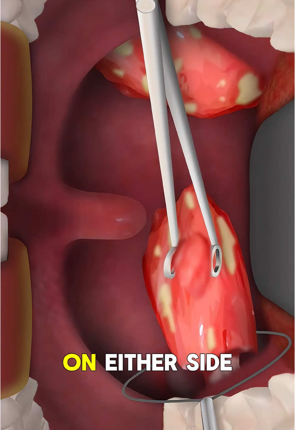 Tonsillectomy Procedure (3D Animation) | Tonsils Removal Surgery  #tonsillectomy #tonsillectomyrecovery #tonsillectomyrecoverytips #tonsillectomycheck #tonsillectomysurgery #tonsilsremoval #tonsilsremovedsurgery #tonsilstonesremoval #tonsilstone #tonsilitis #medical3danimation #3dmedicalanimation 