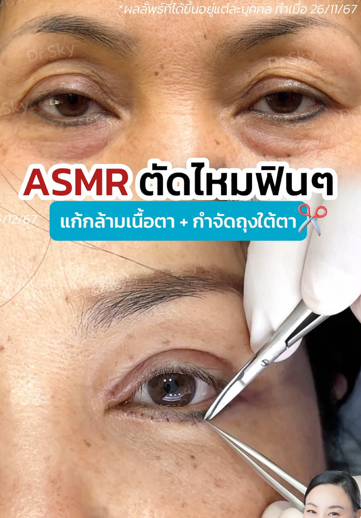 ASMR ตัดไหม ✂️ ทำตาสองชั้น #แก้กล้ามเนื้อตา #กำจัดถุงใต้ตา  เปลี่ยนตาปรือ เป็นตาสวย 🥰 #หมอสกาย #จักษุแพทย์  #หมอตา #skyclinic  #ศัลยกรรมตา #รีวิวตาสองชั้น  #หนังตาตก #สกายคลินิก #ตาปรือ #ทำตาที่ไหนดี #หนังตาตก #หนังตาเยอะ #ผู้สูงอายุ #เคสแก้ตา #ตัดถุงใต้ตา #asmr 