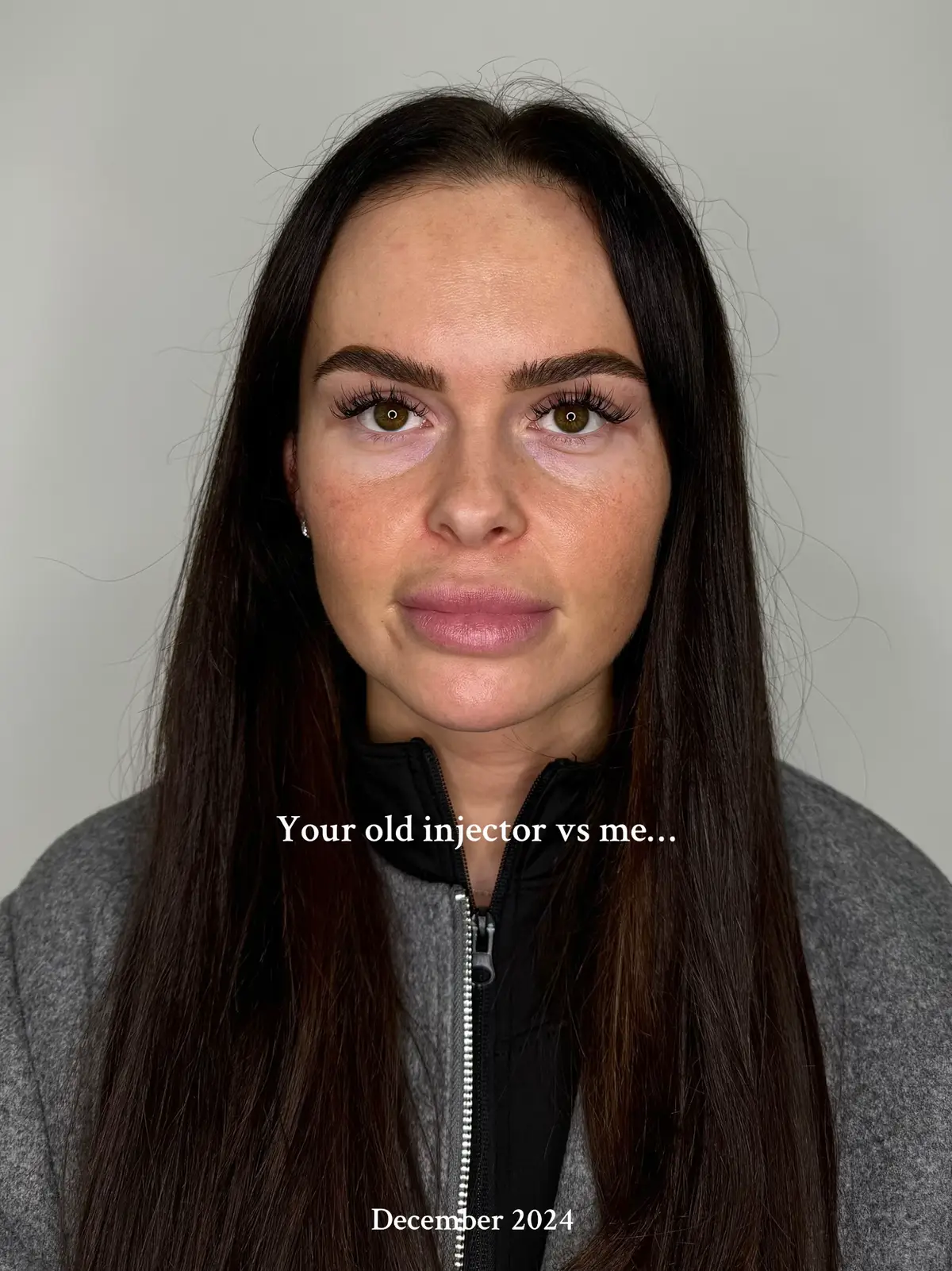 An example of what ‘paying for the skill, not the ml’ really means when it comes to aesthetics  #manchesteraesthetics #aestheticsmanchester #leedsaesthetics #lipfiller #teartroughfiller #clientreveal #nonsurgicalrhinoplasty #lipfiller #lipdissolving #beforeandafter #lipenhacement #dermalfillers #chinenhancement #profilebalancing #facialbalancing 