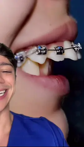 Aparelho ajeitando em tempo real dentes pra frente